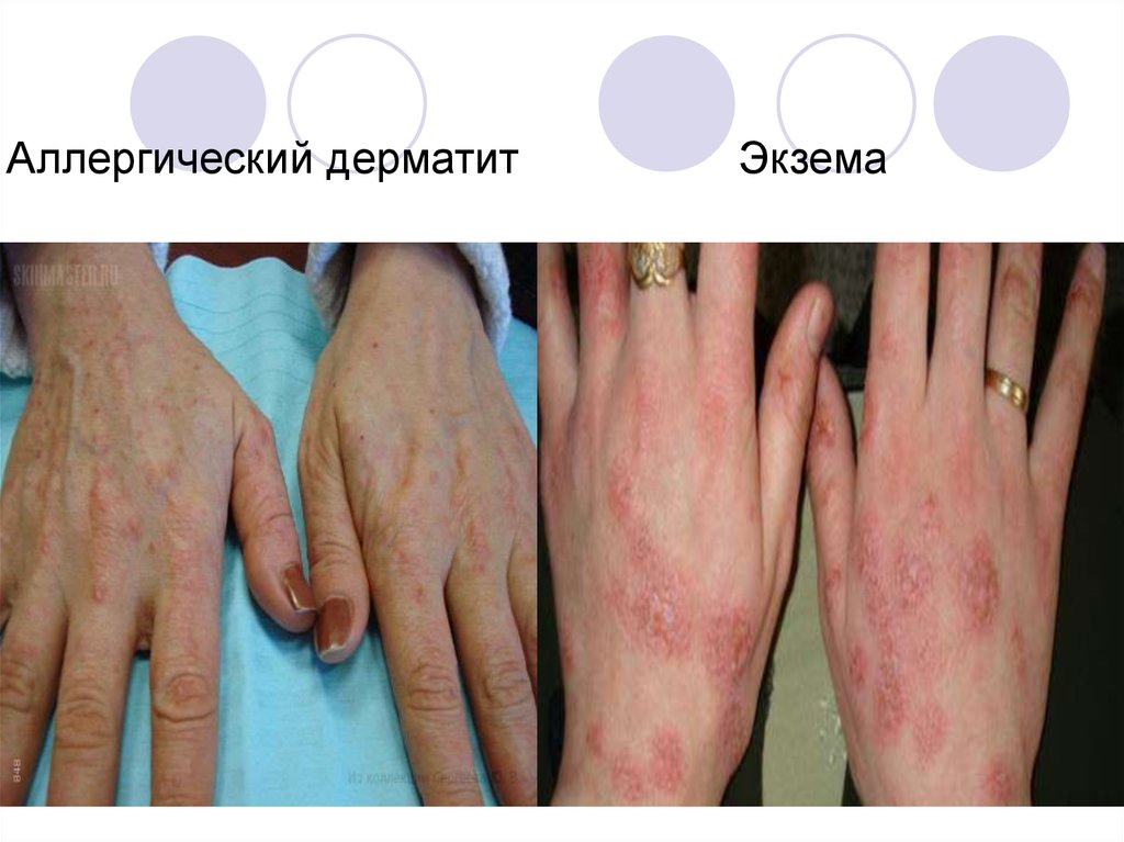 Аллергический дерматит на спине фото