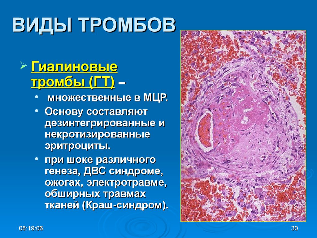 Описание тромба. Гиалиновый тромб гистология. Фибриновый тромб гистология. Составные части гиалинового тромба. Виды тромбов.