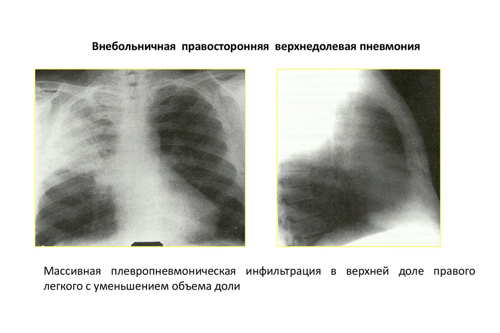 Поражения правого легкого. Долевая крупозная пневмония рентген. Правосторонняя нижнедолевая очаговая пневмония рентген. Правосторонняя очаговая пневмония рентген. Внебольничная очаговая пневмония рентген.