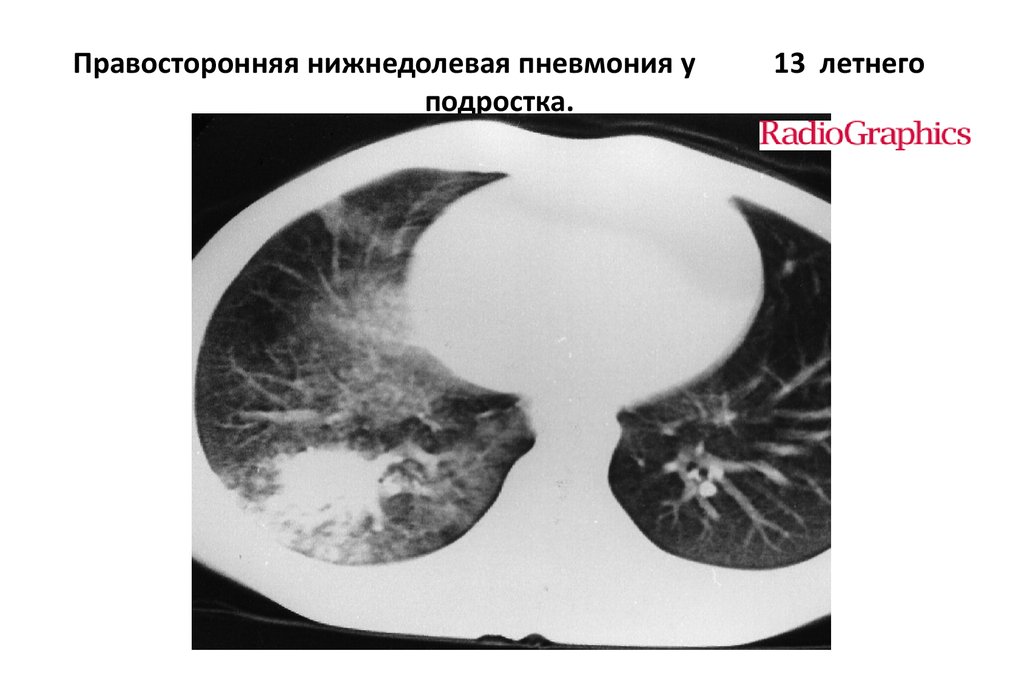 Правосторонняя пневмония. Очаговая пневмония на кт легких. Левосторонняя пневмония на кт. Нижнедолевая пневмония кт. Очаговая пневмония кт.