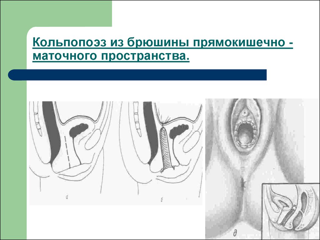 Аномалии развития женских половых органов - onlinepresentation