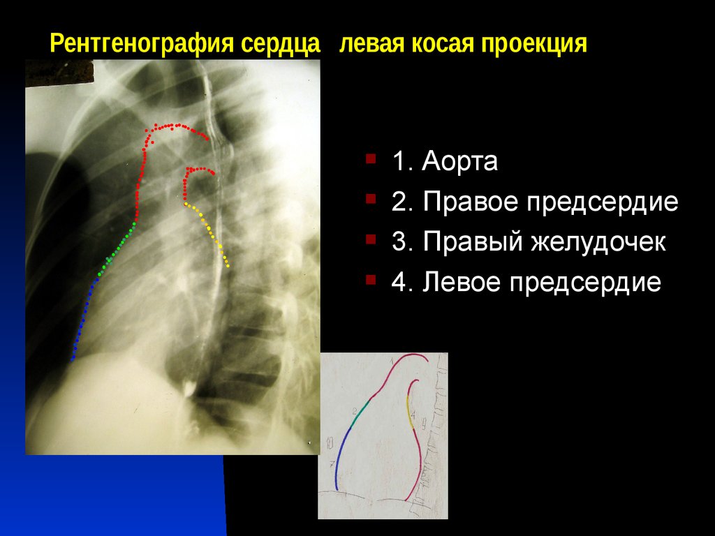 Рентген сердца. Левая косая проекция сердца. Левая косая проекция сердца рентген. Рентгенограмма сердца в левой косой проекции. Первая косая проекция сердца.