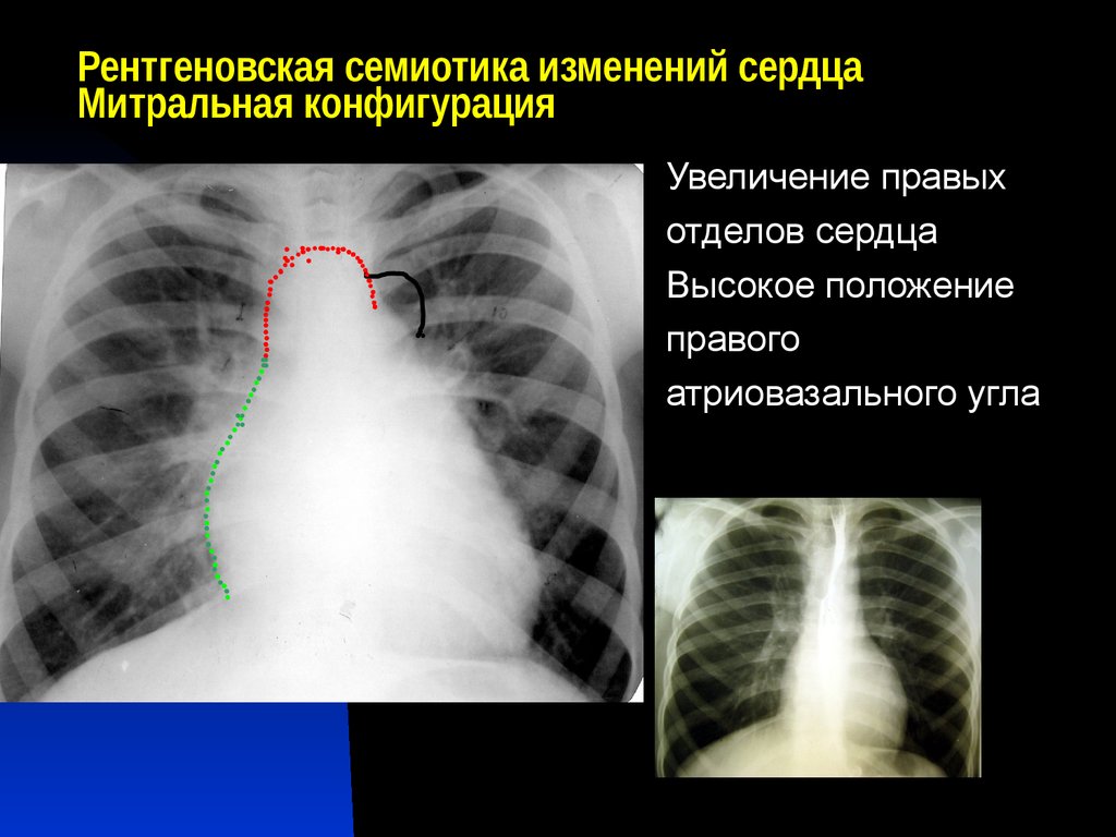 Дилатация правых отделов. Легочная конфигурация сердца. Митральная конфигурация сердца на рентгенограмме.