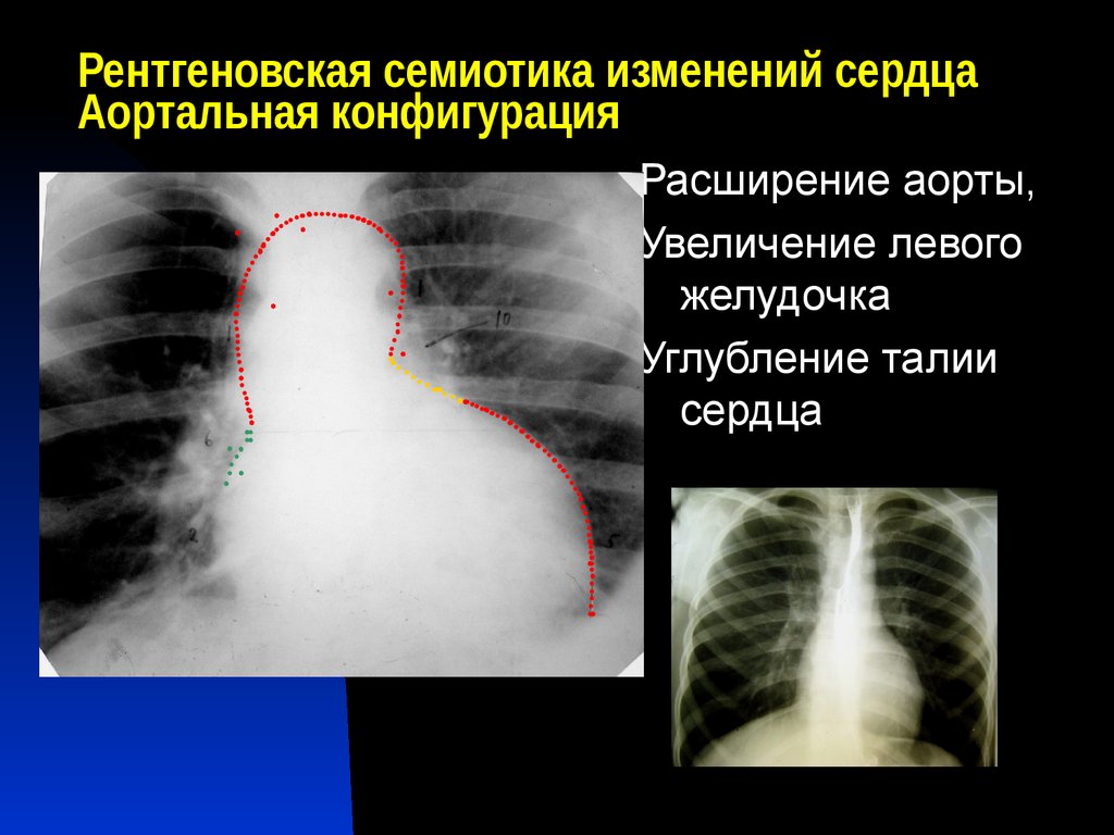 Конфигурация сердца аортальная схема