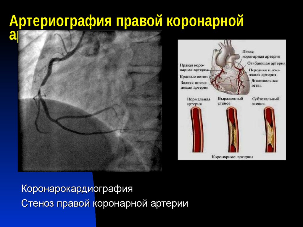 Сужение правой артерии. Стеноз коронарных артерий на УЗИ. Стеноз левой огибающей артерии. Коронарные артерии сужения корон. Правая коронарная артерия коронарография.