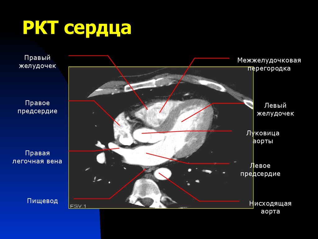 Правом желудочке. Клапаны сердца кт анатомия. Анатомия сердца НАК кт. Левое предсердие кт анатомия.