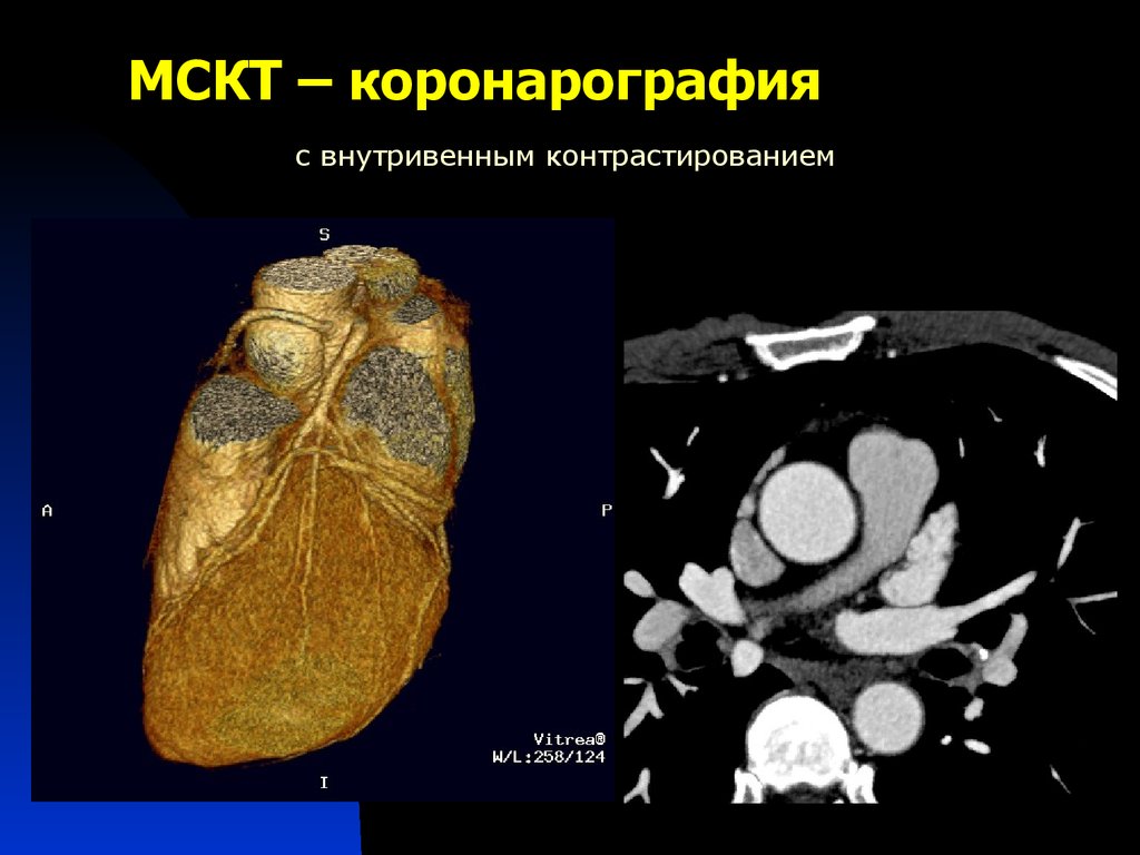 Мскт с контрастированием. Кт коронарография сосудов сердца. Кт коронарография сосудов сердца с контрастом. МСКТ сердца и коронарных сосудов. Мультиспиральная кт коронарных артерий.