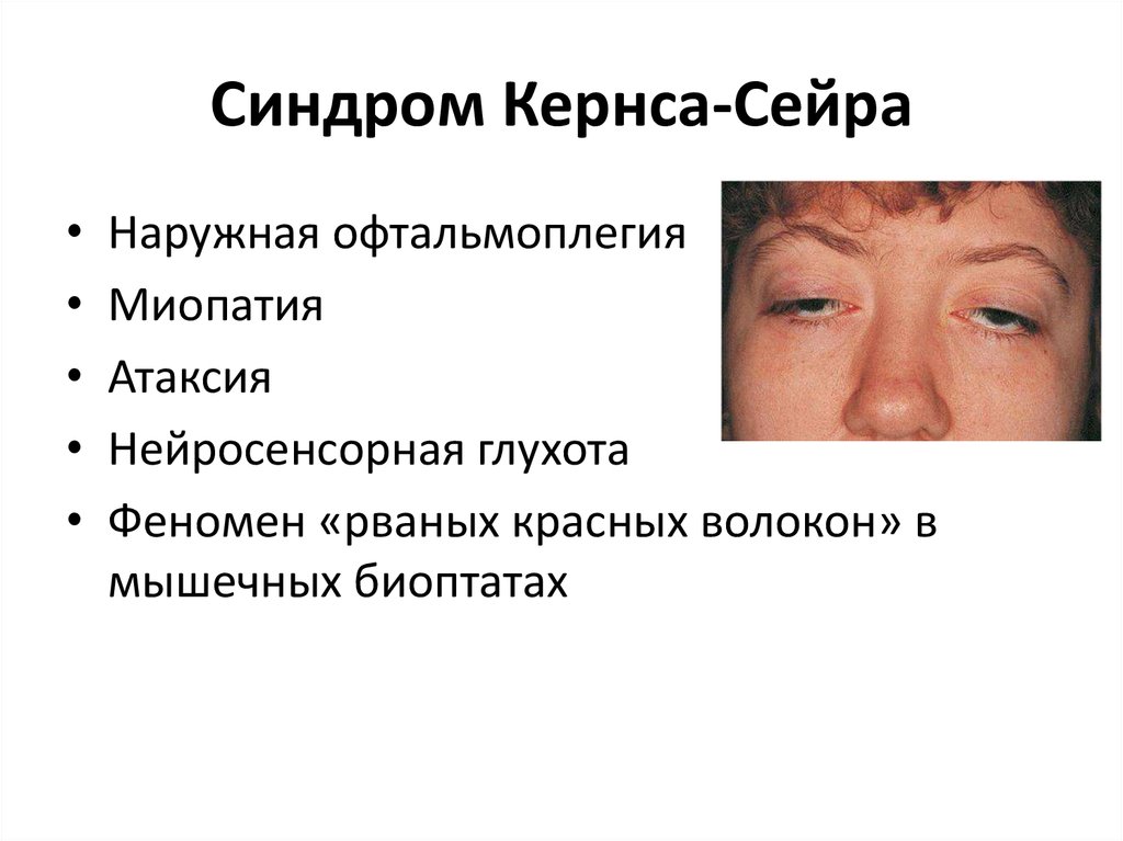 Синдром тельце. Синдром офтальмоплегия (наружная, внутренняя, тотальная). Синдром Кернса-Сейра симптомы. Синдром наружной офтальмоплегии.