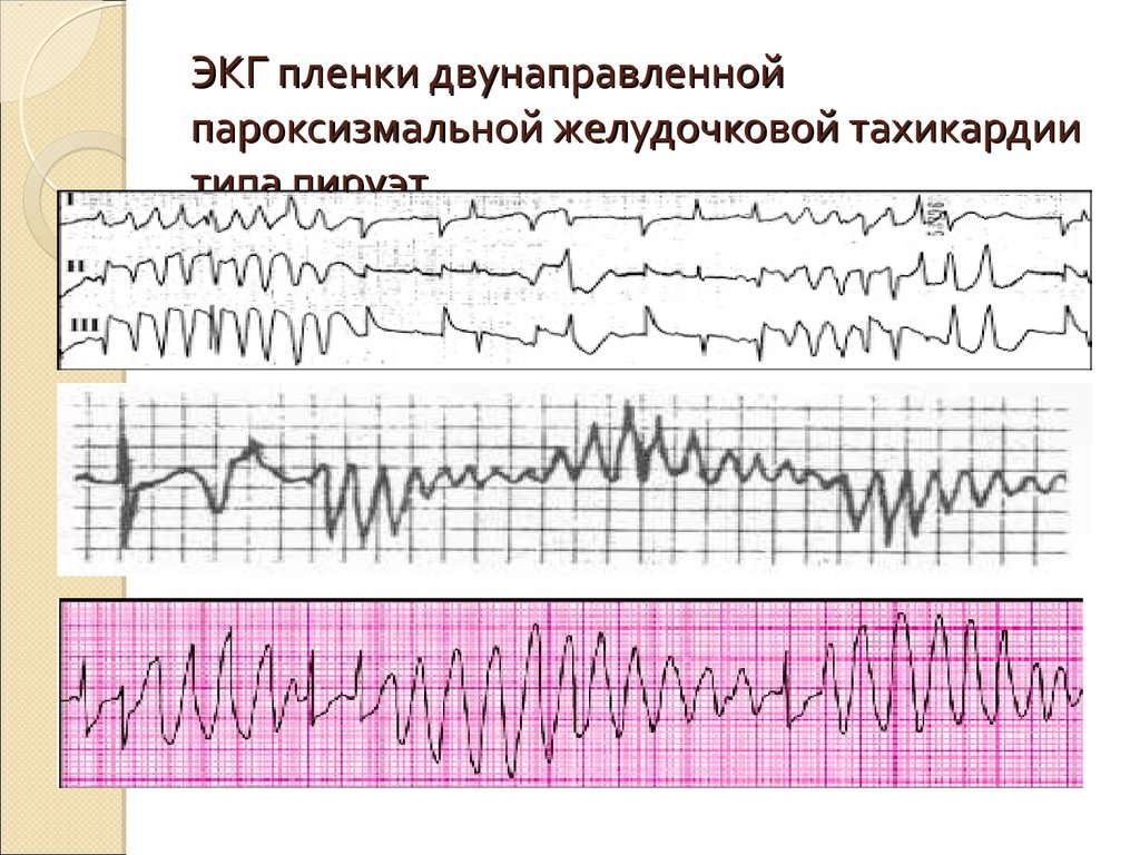 Желудочковая тахикардия экг фото