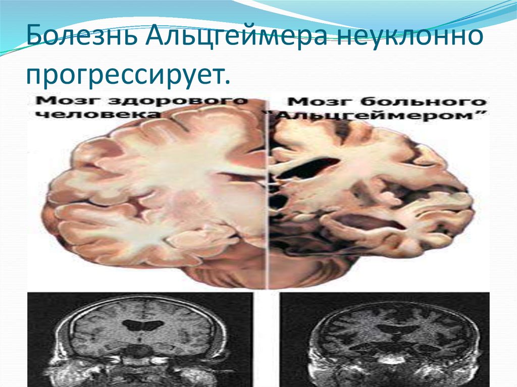 Болезнь Альцгеймера неуклонно прогрессирует.
