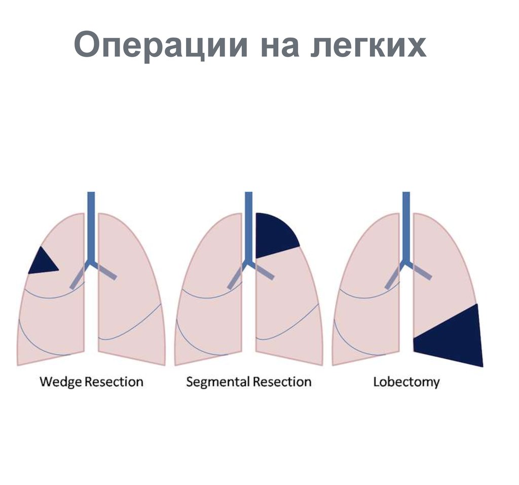 Операция на легких. Типичные операции на легких.