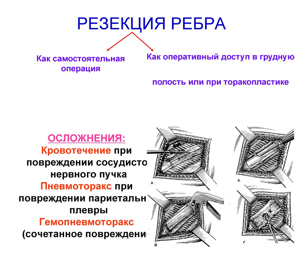 Резекция ребра презентация