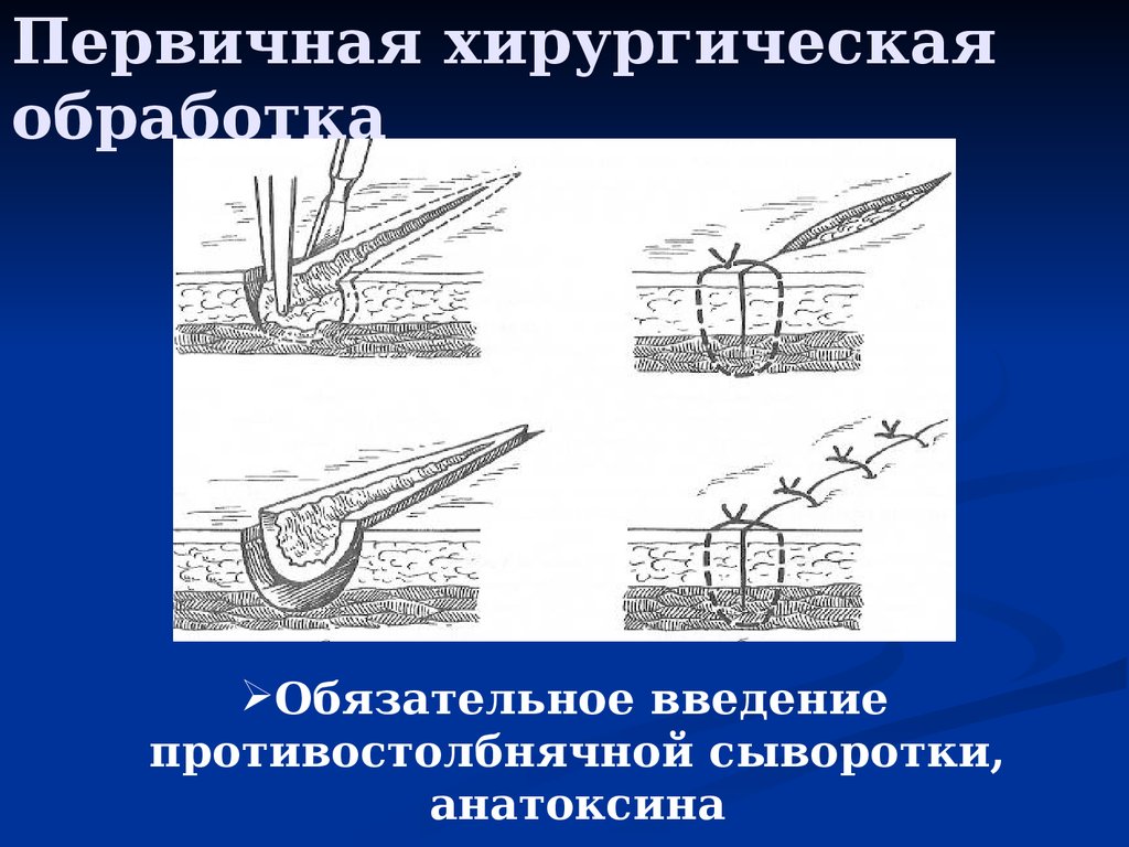 Первичная хирургическая обработка раны