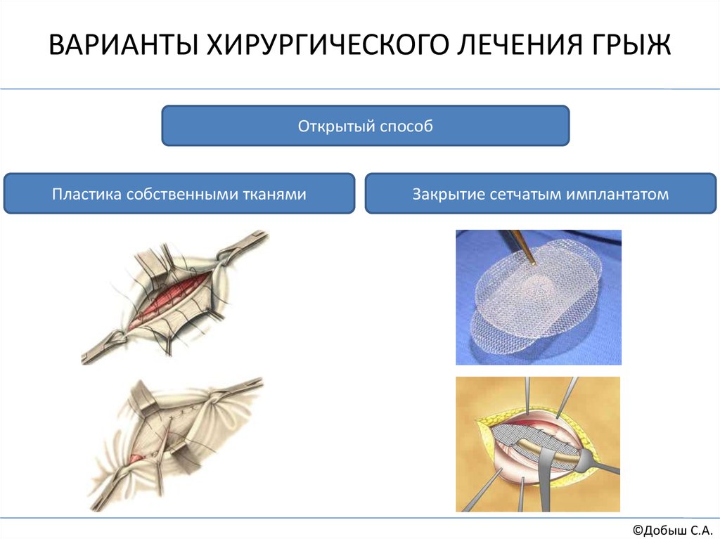 Раскрыть способ. Варианты хирургического лечения. Методы хирургического лечения грыж. Принципы хирургического лечения грыж. Варианты хирургической обработки.