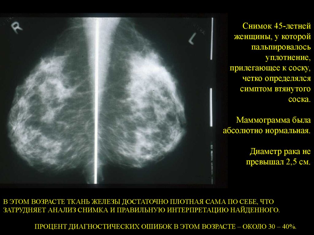 Маммография уплотнения. Анатомия молочной железы маммография. Втяжение Соскана мамиографтт. Онкология на маммографии. Втянутый сосок на маммографии.