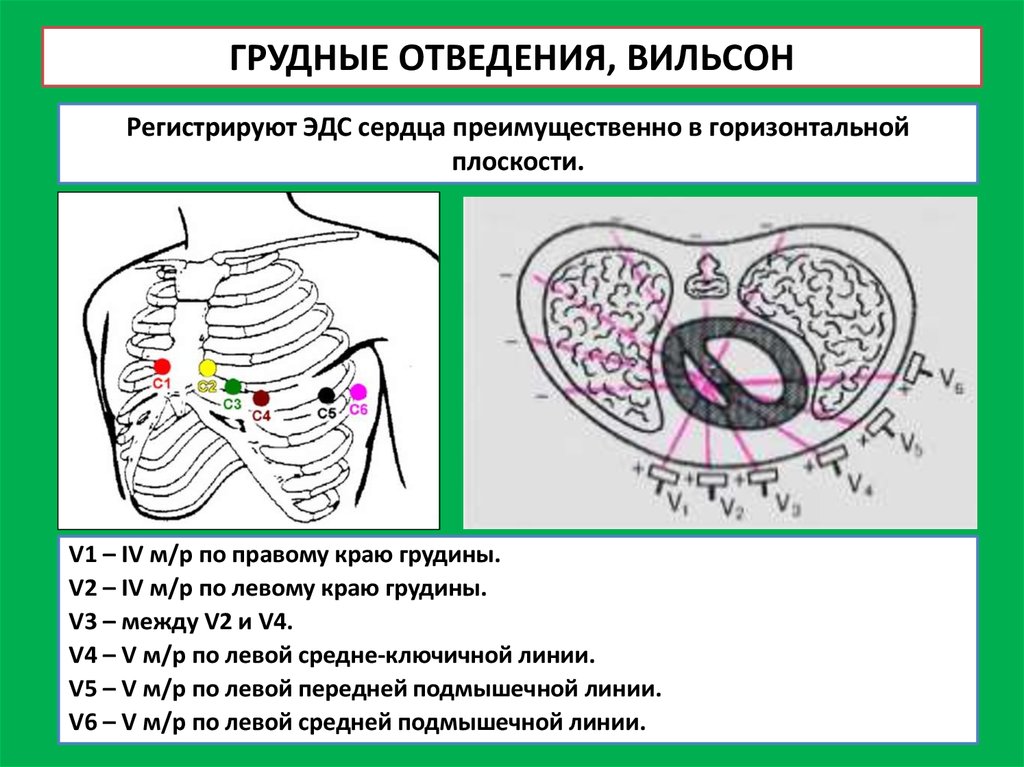 Отведения Вильсона. Грудные отведения по Вильсону. Отведения v3r v4r. Отведения Вильсона рисунок.