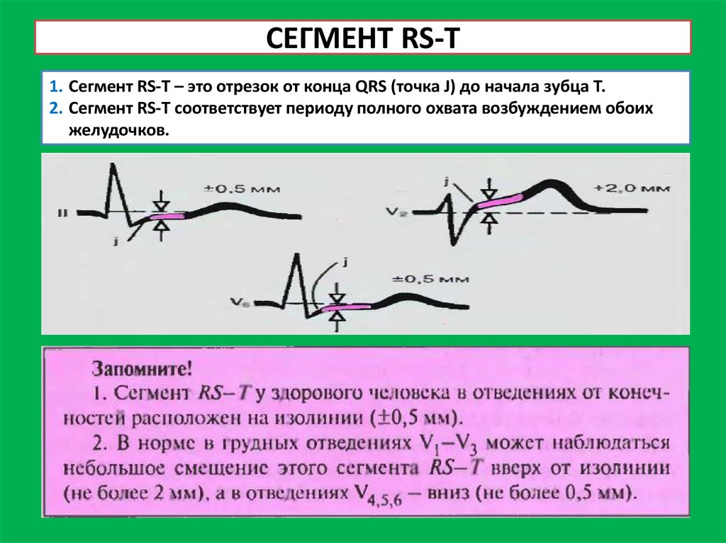 Низкий сегмент. Сегмент. Сегмент RS. Сегмент QRS. Сегмент RS - T В норме.