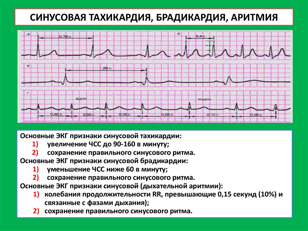 Сильное сердцебиение температура. Брадикардия синусовая аритмия ЭКГ. Нарушение сердечного ритма синусовая тахикардия. Брадикардия на ЭКГ при аритмии. Синусовая брадикардия на ЭКГ.