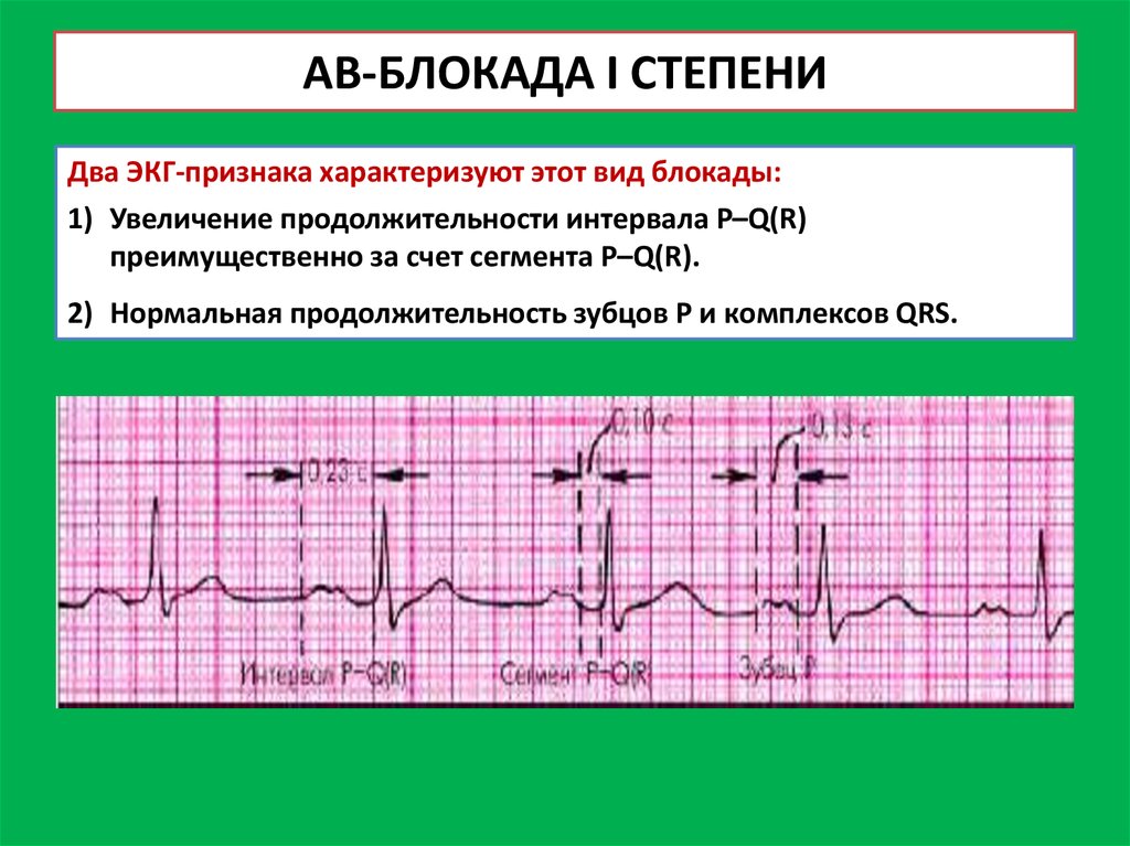 Ав блокады картинки