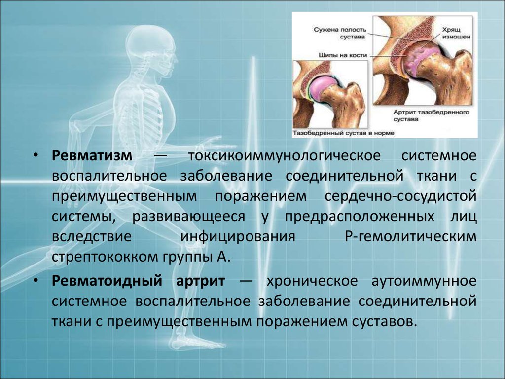 Патология тазобедренного сустава. Ревматизм это системное заболевание. Ревматизм системные заболевания соединительной ткани.