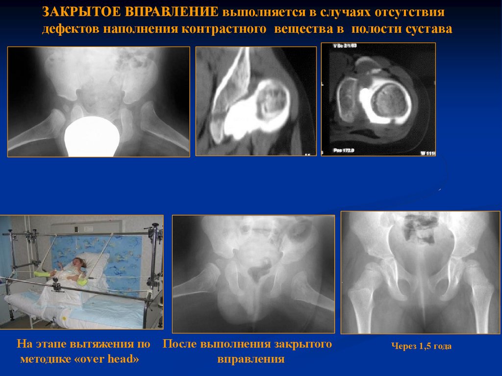 Схема врожденного вывиха бедра