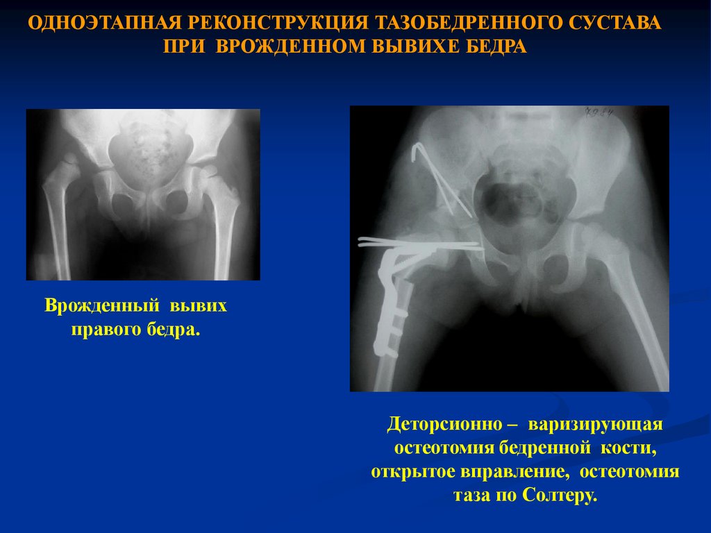 Врожденный вывих бедра презентация