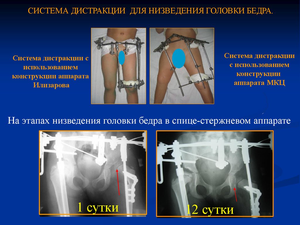 Врожденный вывих бедра симптомы