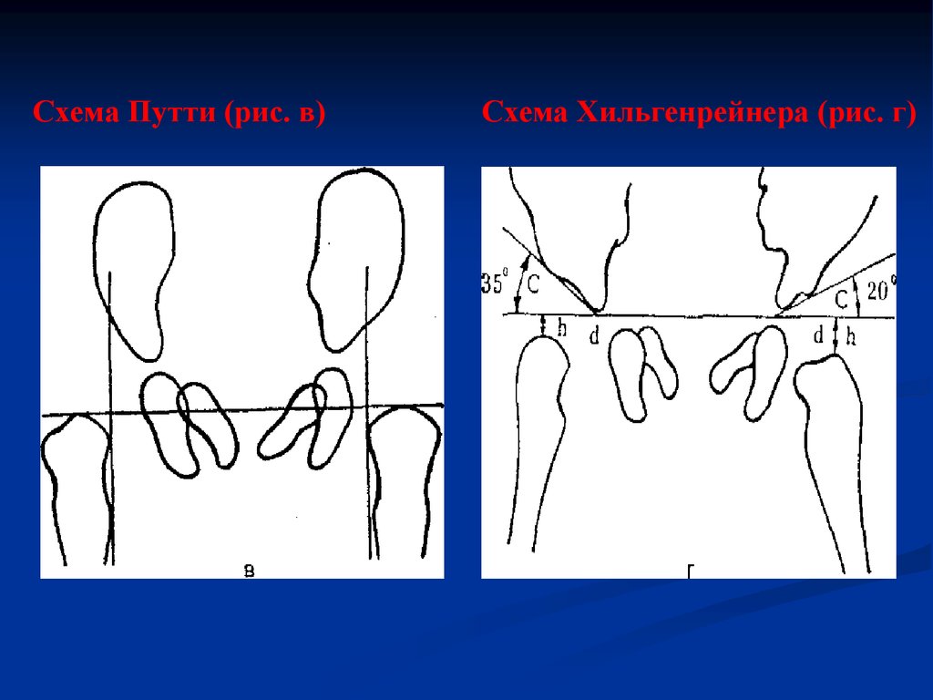 Вывих бедра презентация