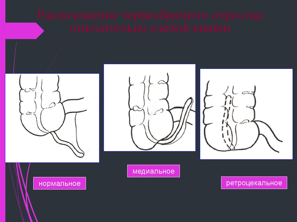 Варианты аппендицита. Ретроцекальное ретроперитонеальное расположение аппендикса. Ретроцекальное расположение аппендицита. Ретроцекальное расположение червеобразного. Ретроперитонеальное расположение червеобразного отростка.