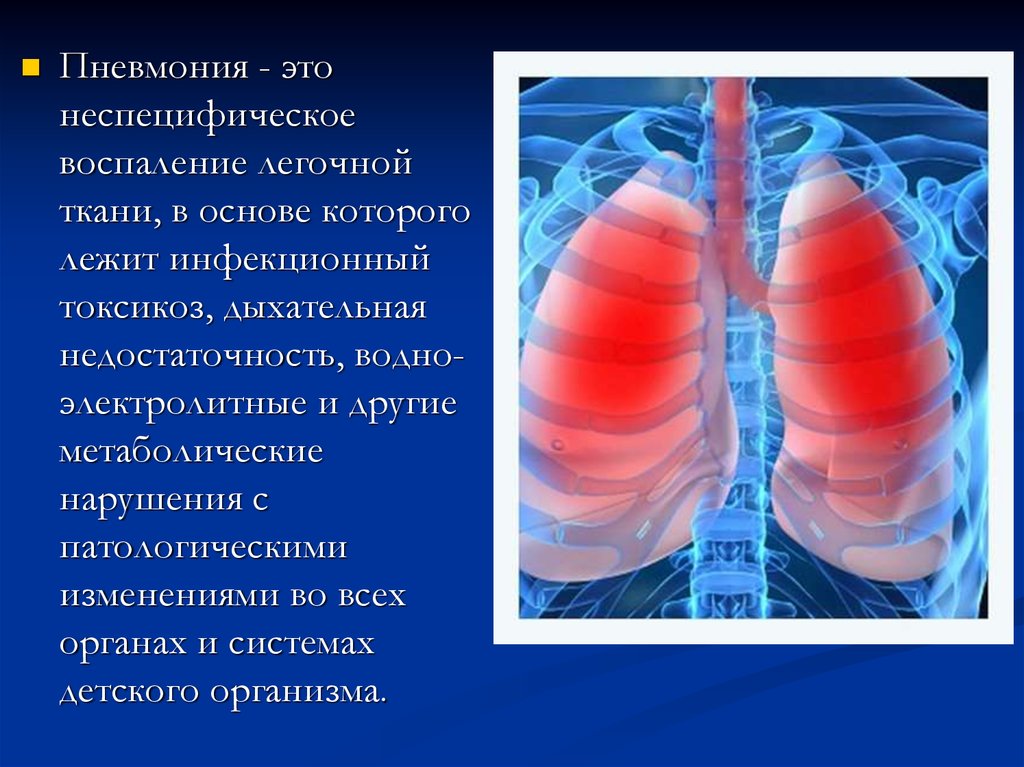 Воспаление легких это. Пневмония. Неспецифическая пневмония. Пневмония с инфекционным воспалением легочной ткани. Воспаление легочной ткани.