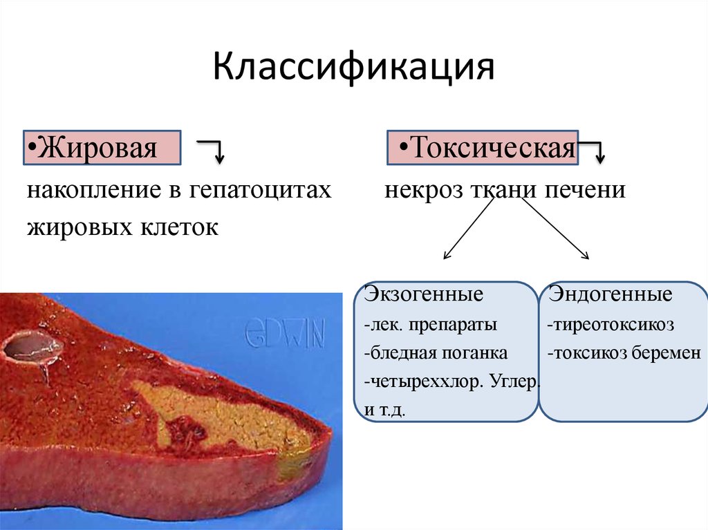 Гепатомегалия признаки жирового гепатоза