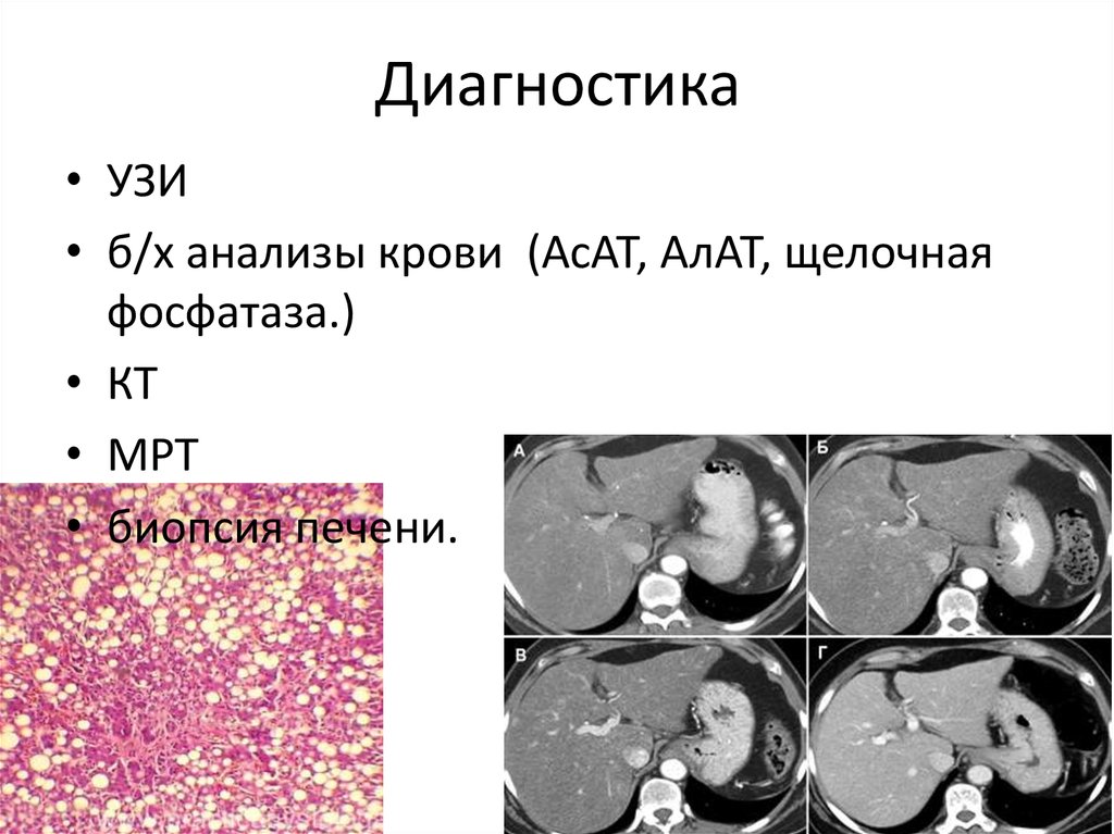 Алат асат щелочная фосфатаза. Диагностические возможности биопсии печени презентация. Печень и селезенка вирус эйштен асаты алтаты.