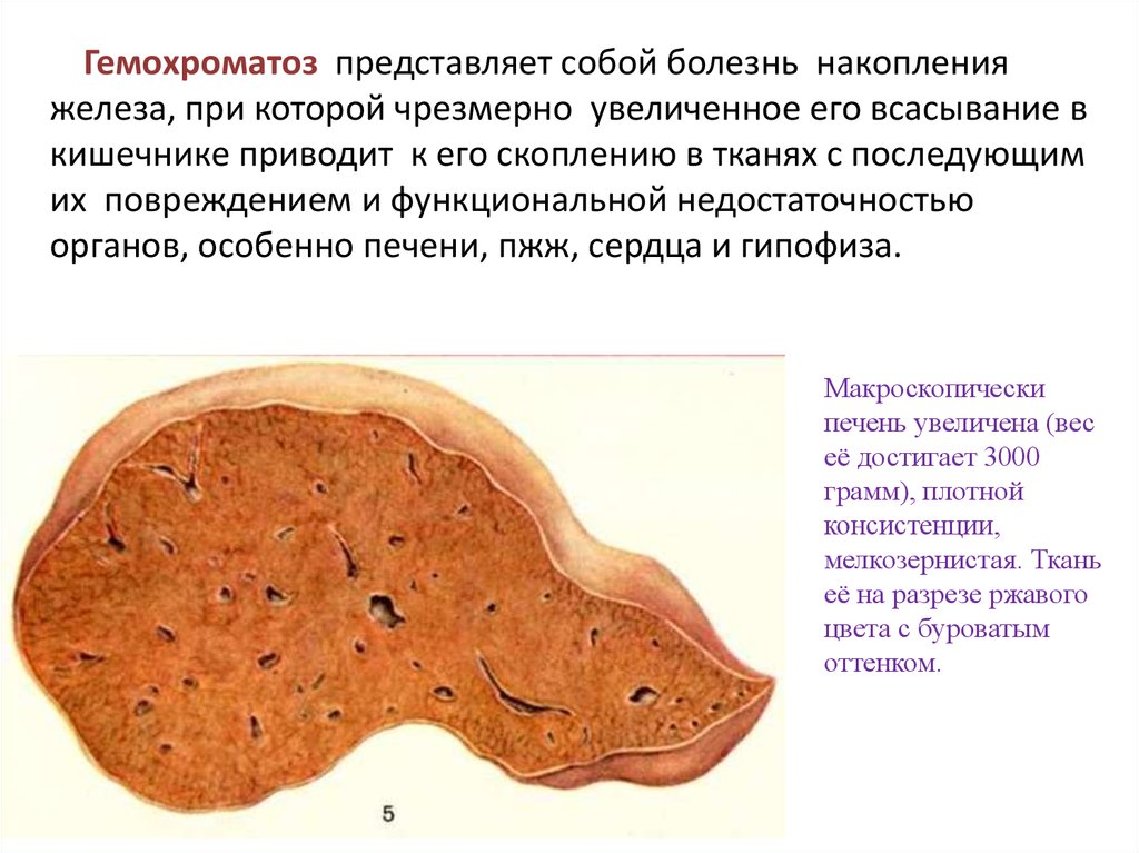 Печень и железо в крови. Гемохроматоз печени патологическая анатомия. Наследственный гемохроматоз печень. Макропрепарат болезни печени. Бронзовая кожа гемохроматоз.