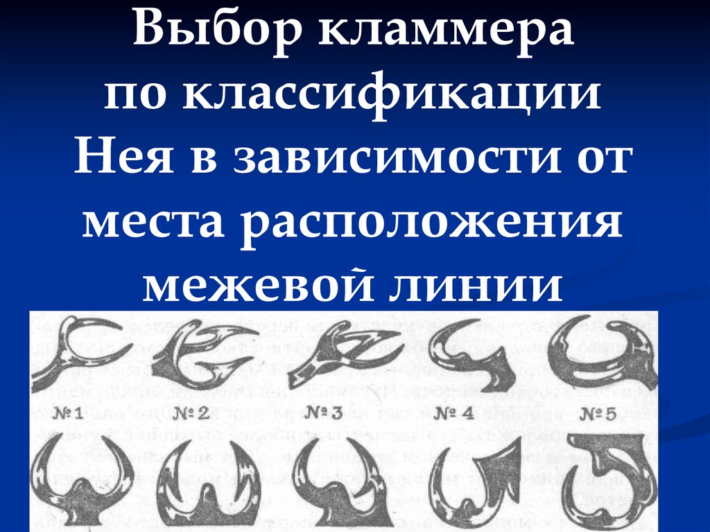 Классификация нея. Классификация кламмеров. Классификация нея кламмеров. Кламмеры системы нея. Классификация каммеров ноя.