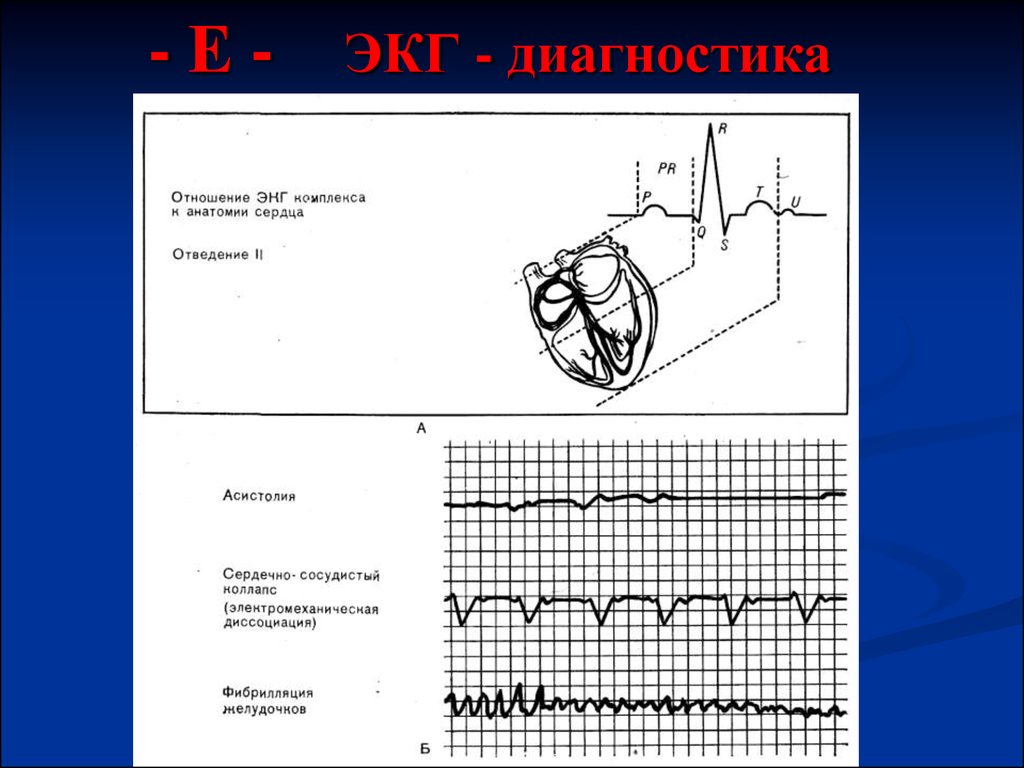 Экг диагностика. АВ диссоциация с интерференцией на ЭКГ признаки. Av диссоциация на ЭКГ диагноз.