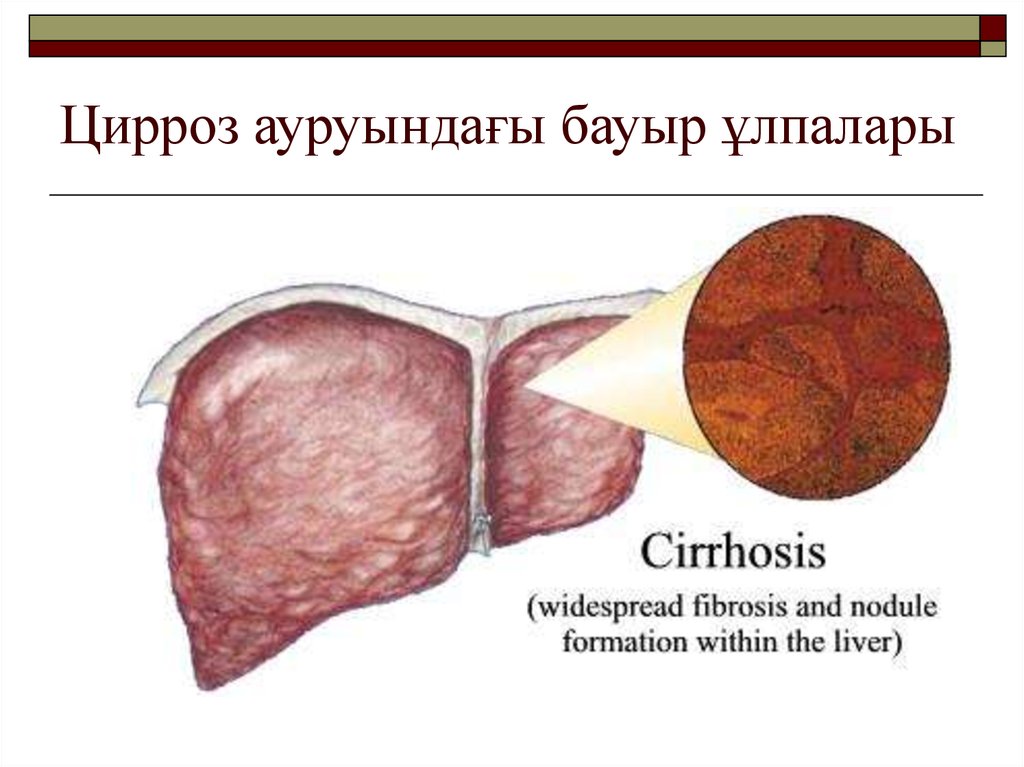 Цирроз печени схема