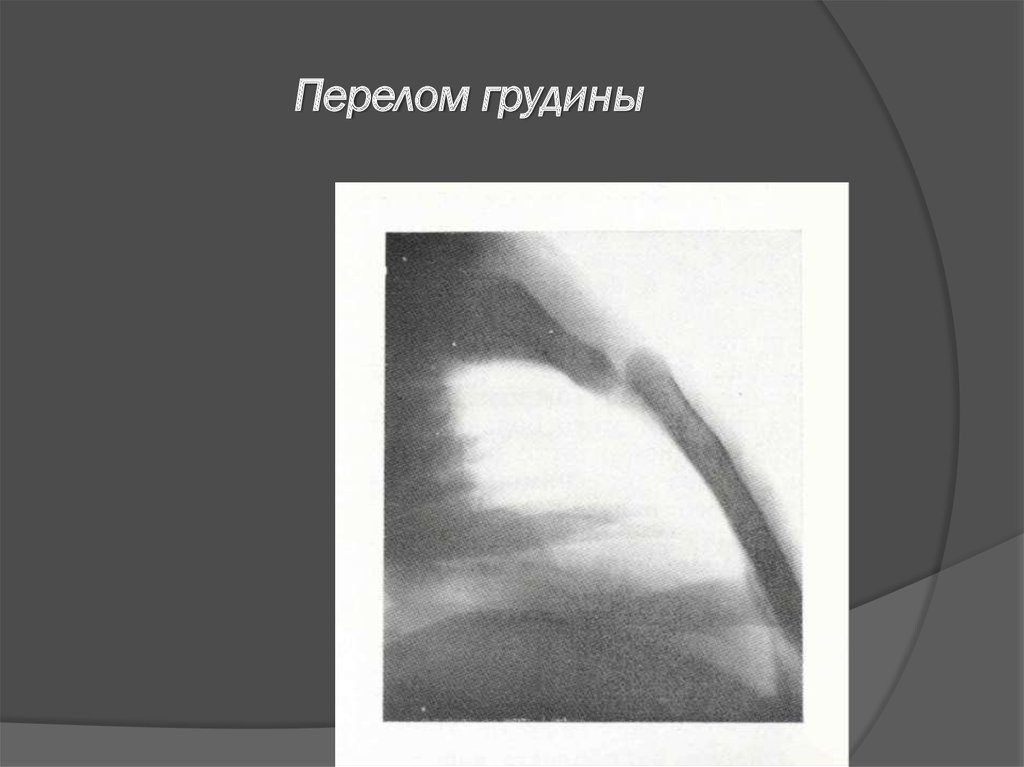 Перелом грудины. Перелом грудины рентгенограмма. Перелом тела грудины на кт. Рентгенография перелом грудины. Перелом грудины у детей рентген.