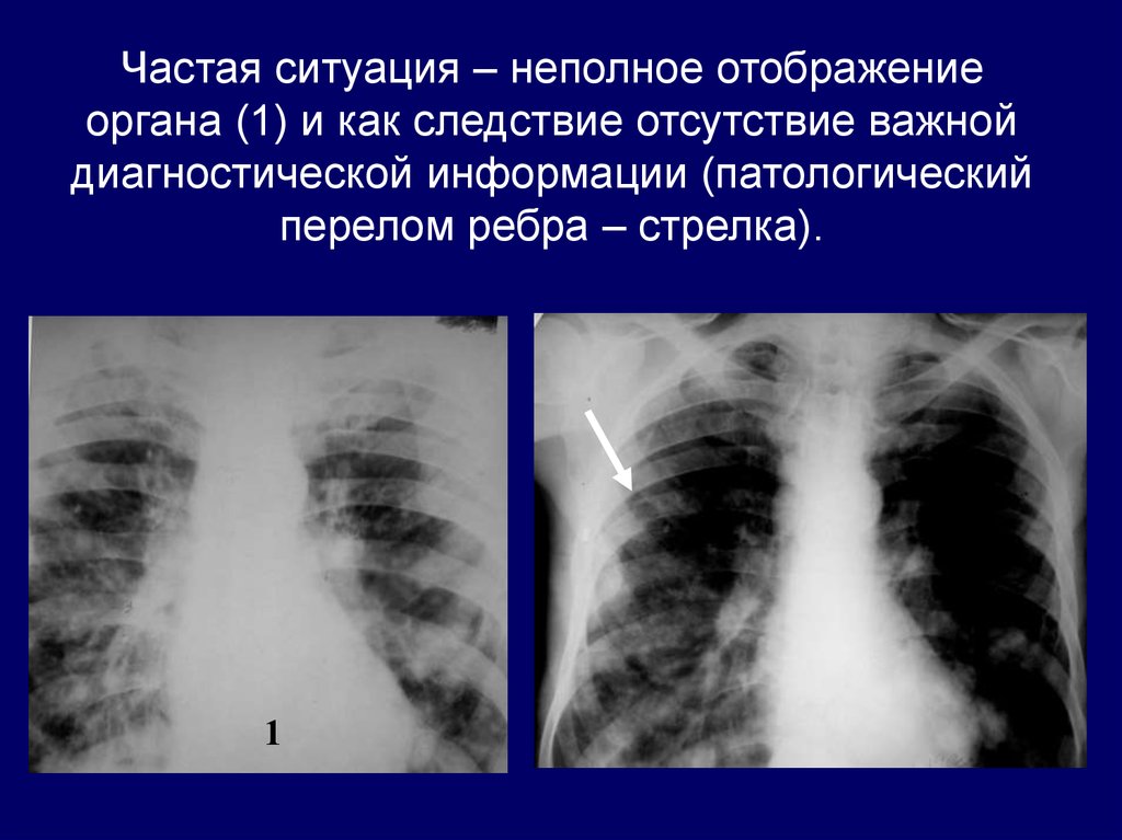 Частая ситуация. Частичное отображение. При зеркальном отображении органов проблемы в легких.