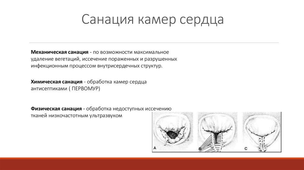 Санация что это. Санация камер при инфекционном эндокардите.