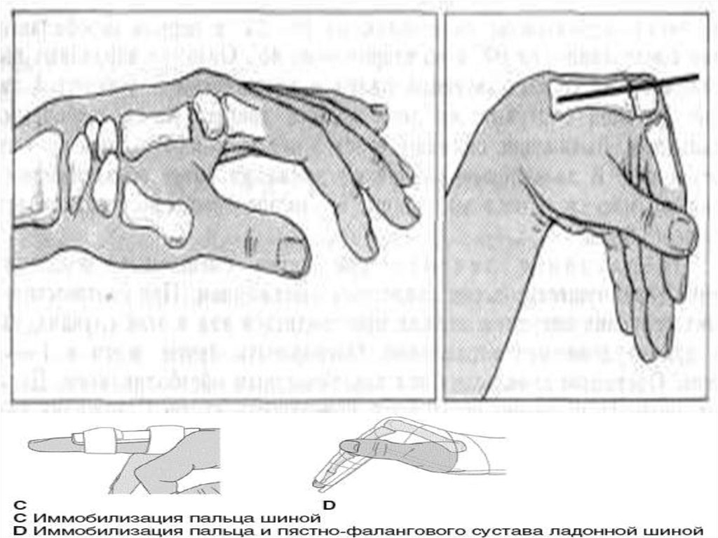 Вывих пальца кисти карта вызова