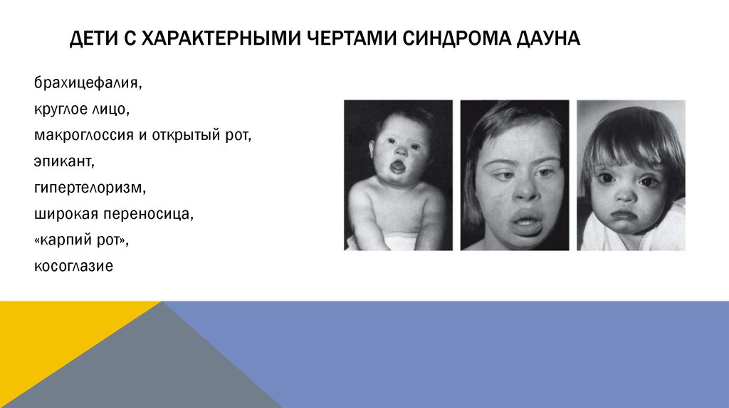 Дауны передаются по наследству. Лицо ребенка с синдромом Дауна.