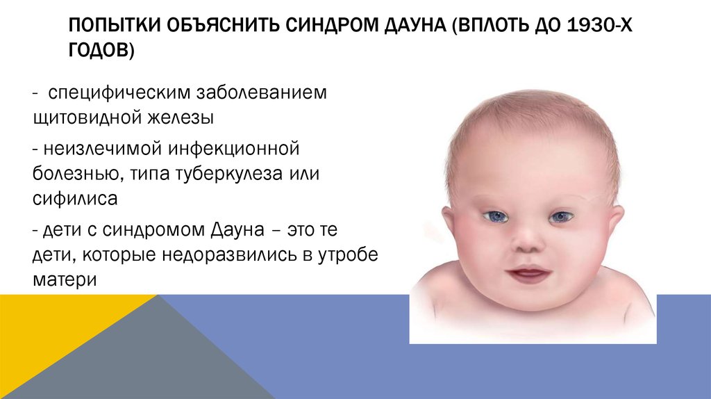 Фенотип ребенка с синдромом дауна. Синдром Дауна. Новорожденный с синдромом Дауна.