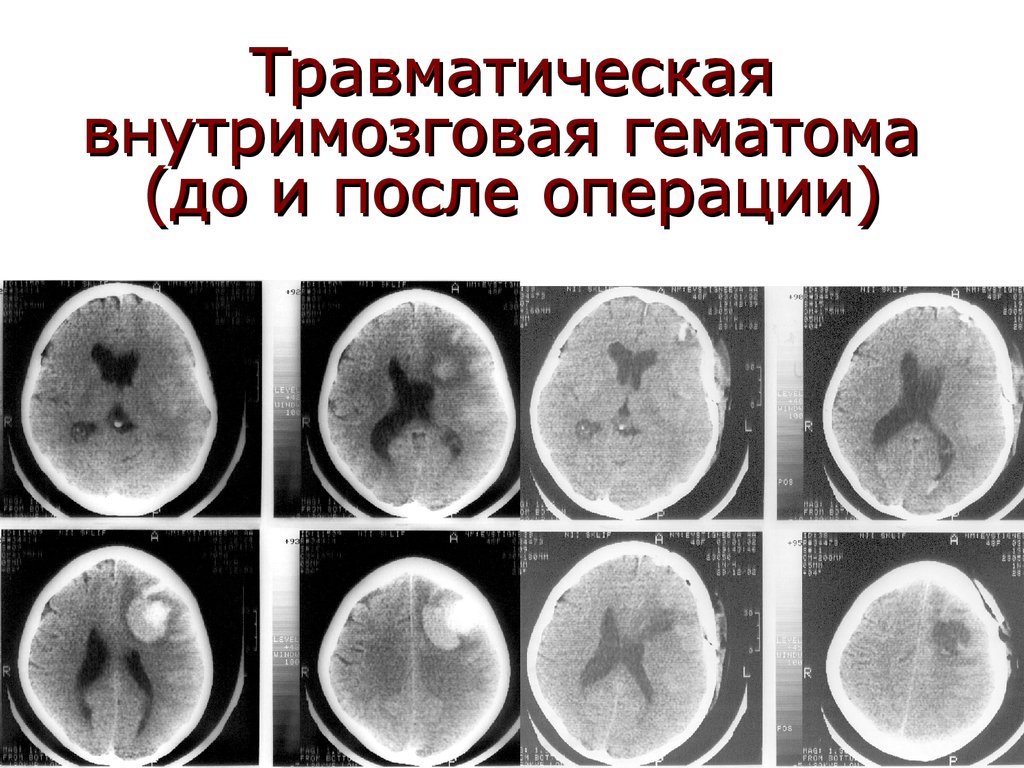 Гематома мозга операция