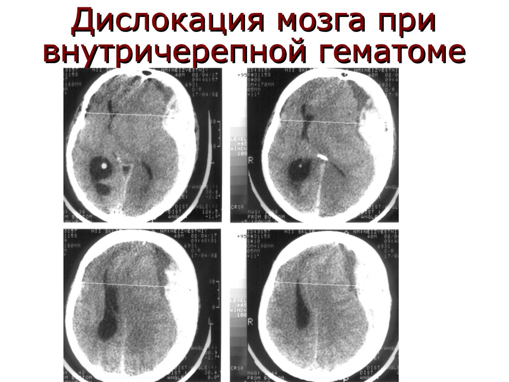 Дислокация мозга при внутричерепной гематоме