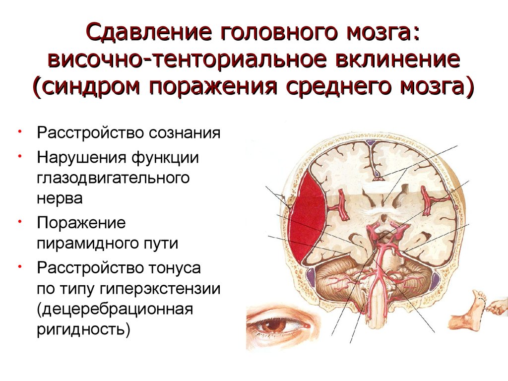 Внутренние признаки головного мозга. Клинический синдром поражения среднего мозга. Височно-тенториальное смещение. Вклинивание ствола мозга симптомы. Сдавливание ствола мозга.