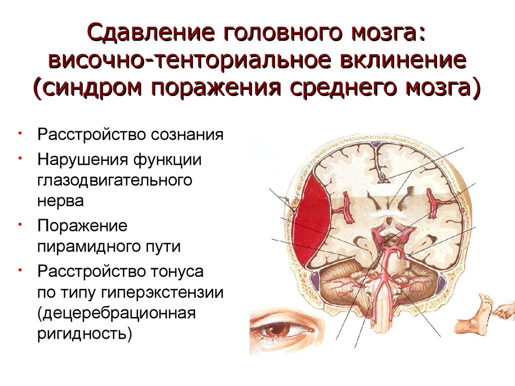 Симптомы головного мозга. Височно-тенториальное смещение. Вклинивание ствола мозга симптомы. Височно-тенториальное вклинение головного мозга. Сдавливание ствола мозга.