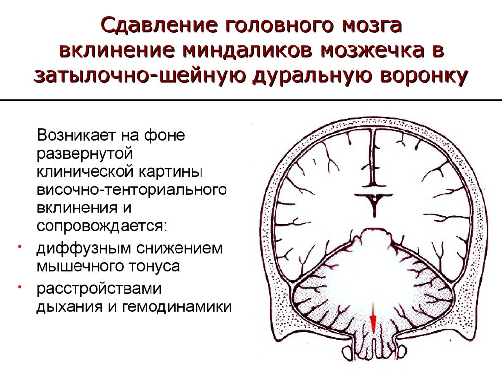 Клиническая головного мозга. Вклинивание ствола мозга симптомы. Вклинение ствола головного мозга кт. Вклинение ствола головного мозга в большое затылочное отверстие. Транстенториальное вклинение.