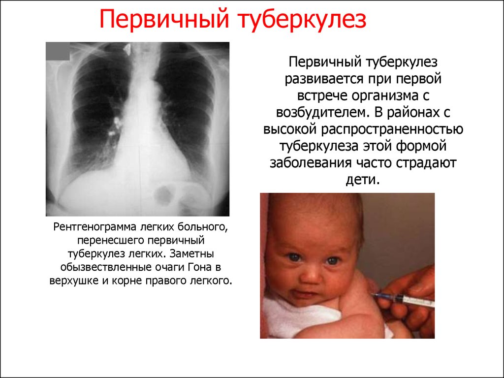 Дети болеют туберкулезом. Первичный туберкулезный комплекс рентген. Первичный туберкулез презентация. Первичным туберкулезом болеют. При туберкулезе развивается:.