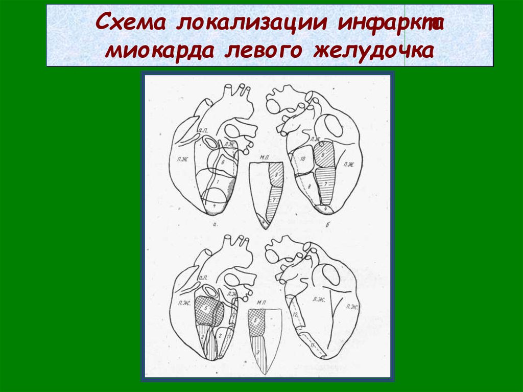 Сегменты миокарда. Локализации инфаркта левого желудочка. Схема инфаркта левого желудочка. Локализация инфаркта в левой лопатке.