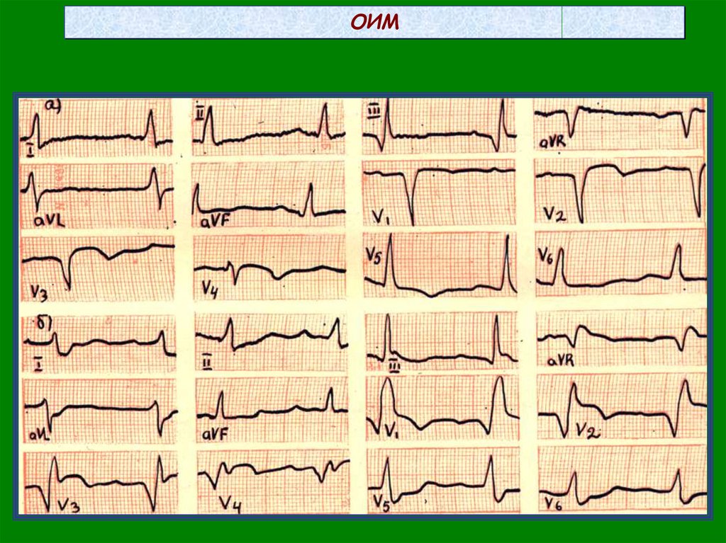 Оим это. Острый инфаркт миокарда ЭКГ. ЭКГ при остром инфаркте миокарда. ОИМ на ЭКГ. Инфаркт миокарда на ЭКГ.